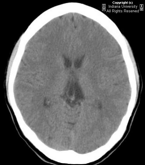 Neuroradiology On the Net Cavum velum interpositum