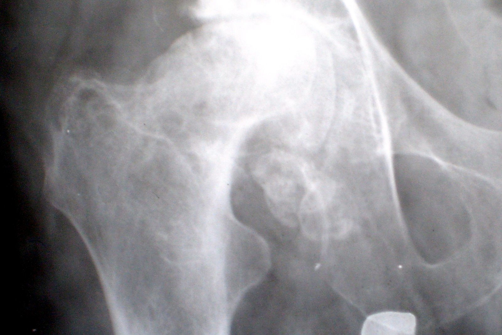 joint care foundation Hip Joint Arthritis