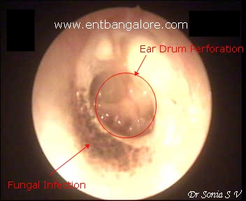 Ear Fungus Pictures