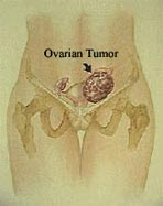 Ovarian Cancer