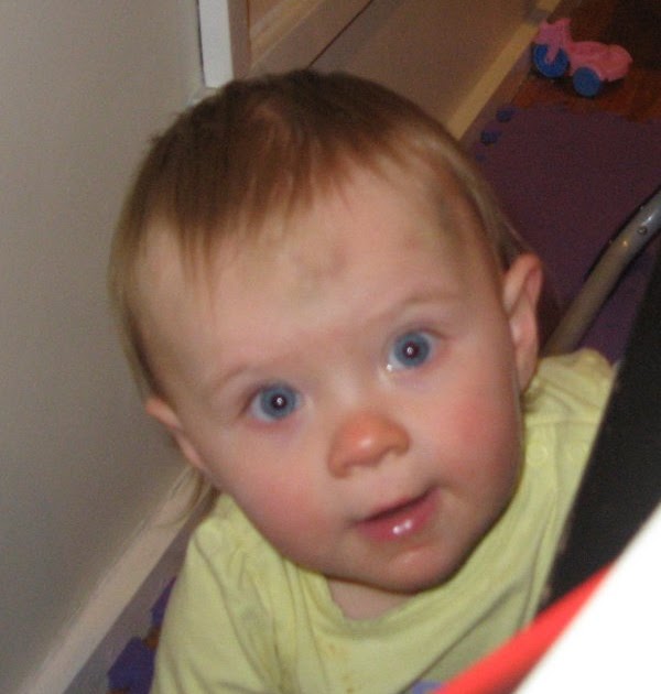 The Baby, She Crazy! Bruised Baby