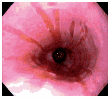 Labels: Acid Reflux Images , GERD diagnosis , REFLUX ESOPHAGITIS ...