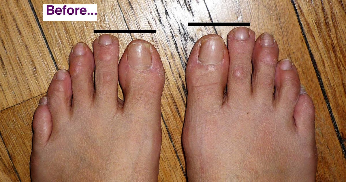 My Toe Shortening Surgery and Hammertoe (Hammer Toe) Surgery Blog Before & Afters 2 Months