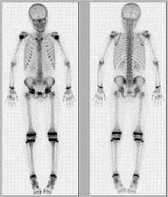 bone scan cancer 2009 wiifm should they medfriendly reasons september