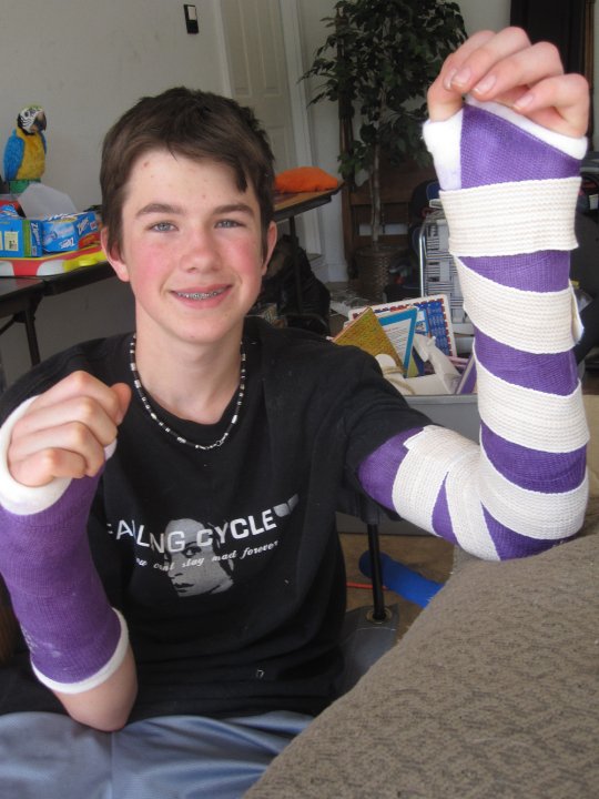 Broke Both Arms