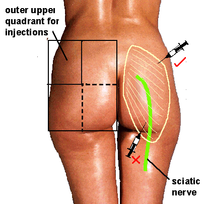 Where to inject steroids in buttocks