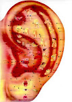 Acupuntura Auricular