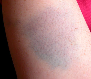 bruises on legs for no reason bruises on legs for no reason