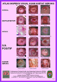CURHAT NISA: Deteksi Kanker Cerviks Dengan IVA
