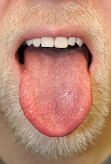 Oral thrush
