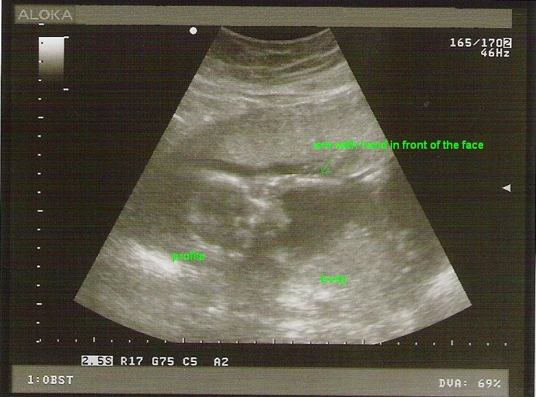 [baby2+19wk+us+1a1.jpg]