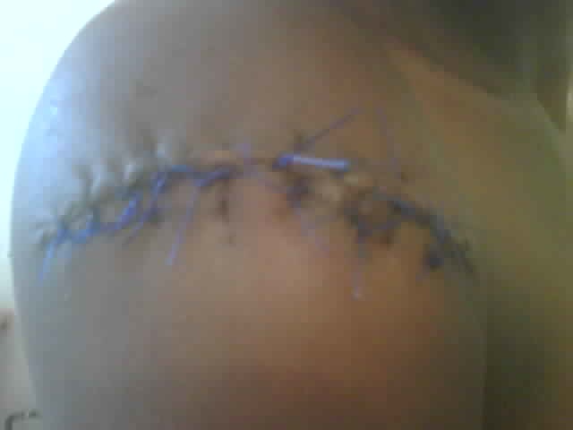 tattoo removal journey tattoo removal journey