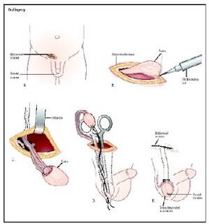 Low hanging testicles