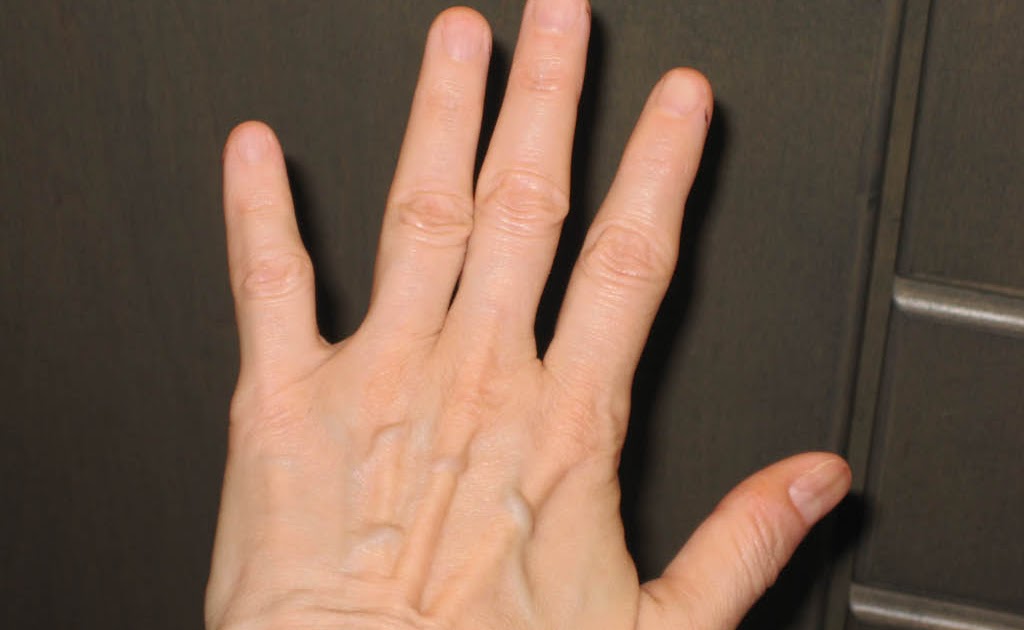 If at first you don't succeed... Life without fingernails