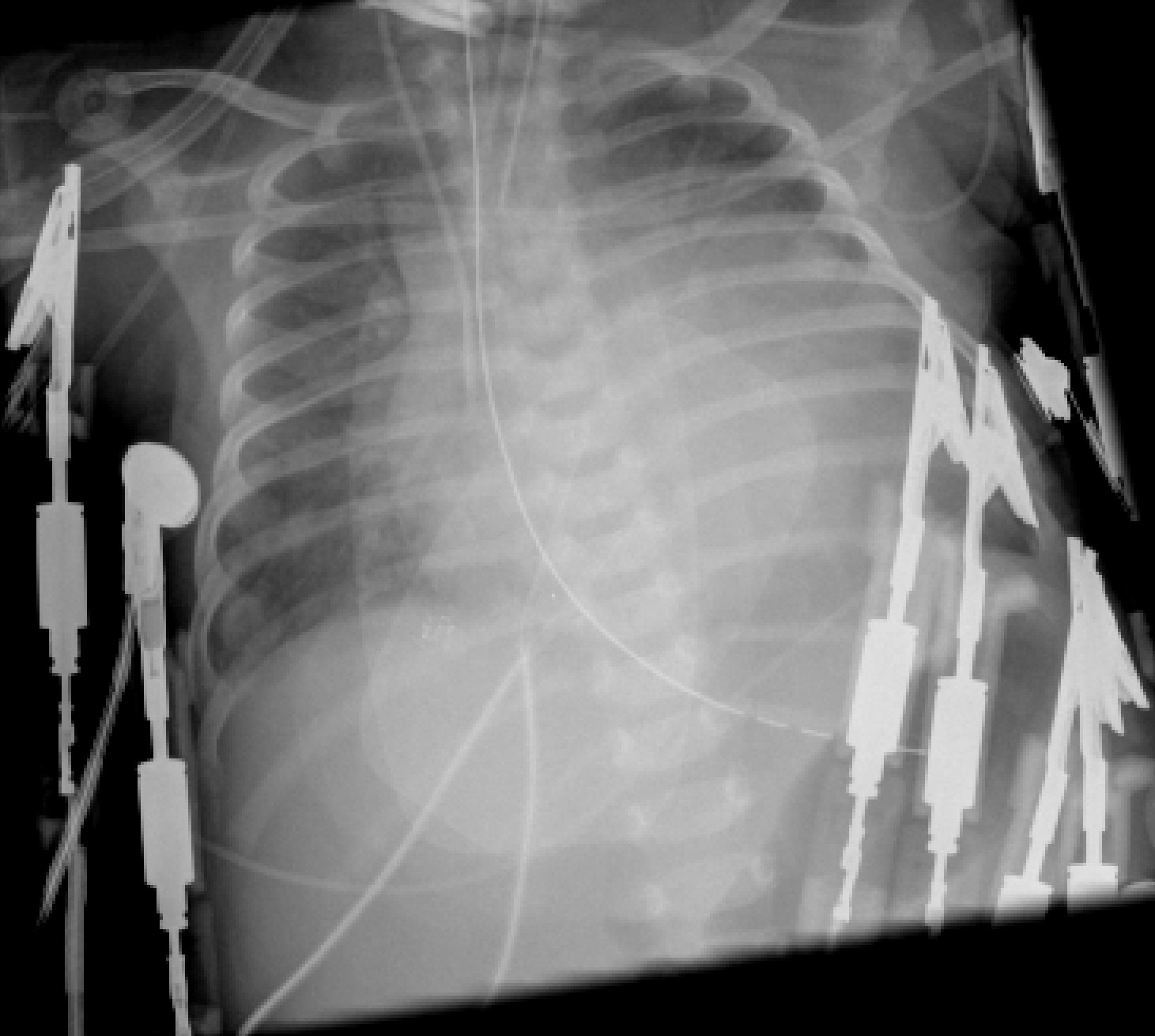 Lv Noncompaction