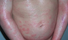 yucky itchy inflamed hives