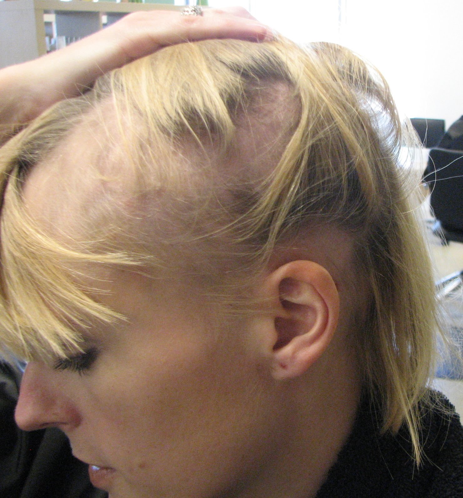 Álbumes 90+ Imagen Why Do The Roots Of My Hair Hurt Lleno