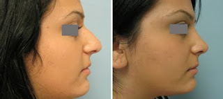 Nose Job Los Angeles