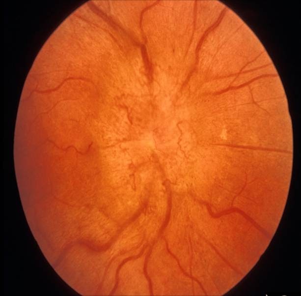 pellucid eye pellucid eye