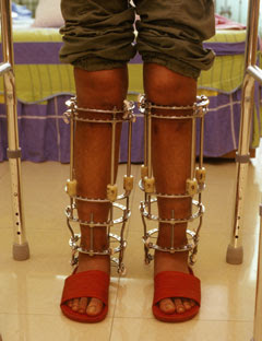 leg length surgery cost