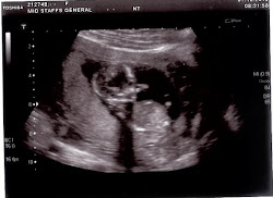 Baby's Second Scan - 13+3