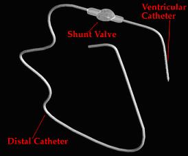shunt vs dead space open anesthesia shunt vs dead space open anesthesia
