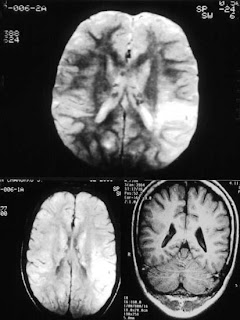 Enfermedades mentales: La norbina Esclerosis+tuberosa