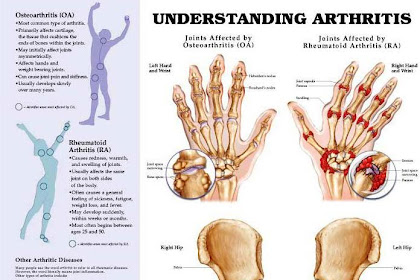 Natural Healing: Can Rheumatoid Arthritis be Treated With Curcumin?