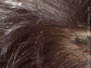 Superfluous Miscellany A Completely Different Subject Head Lice
