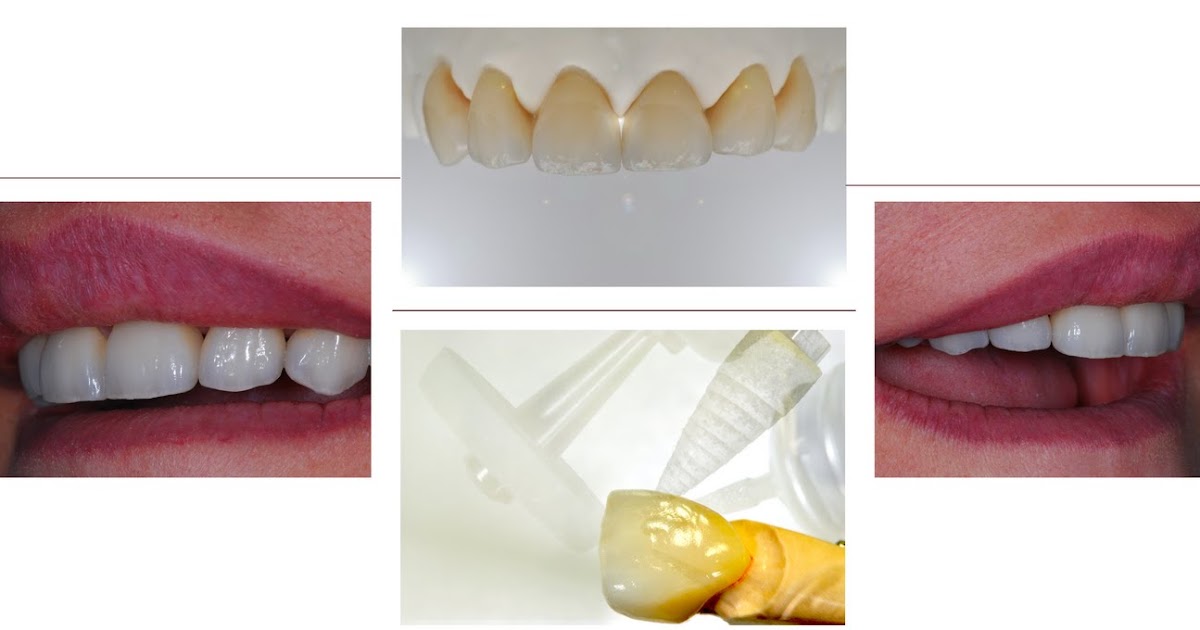 Niche Dental Studio GC/Zirconia