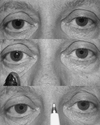 pseudo argyll robertson pupil paurinaud pseudo argyll robertson pupil paurinaud