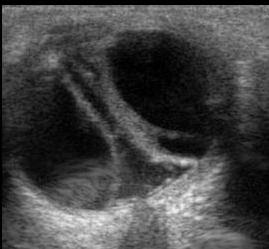 The Suprachoroidal Space Is Normally Virtual Because Choroid In Close Apposition To Sclera As Fluid Accumulates This Becomes Real The Suprachoroidal Space Is Normally Virtual Because Choroid In Close Apposition To Sclera As Fluid Accumulates This Becomes Real