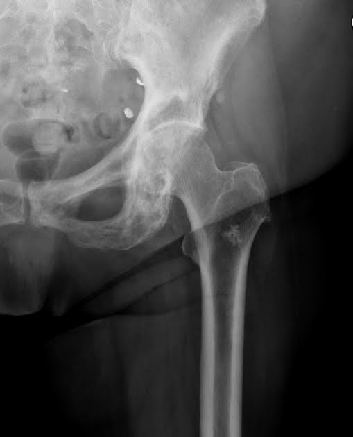 Paget's Disease Sumer's Radiology Blog