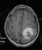 cavernoma mri