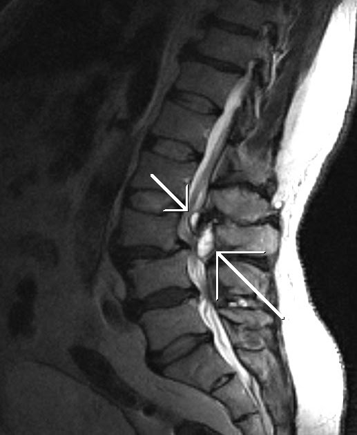 Synovial Cysts of the Facet JointsMRI Sumer's Radiology Blog