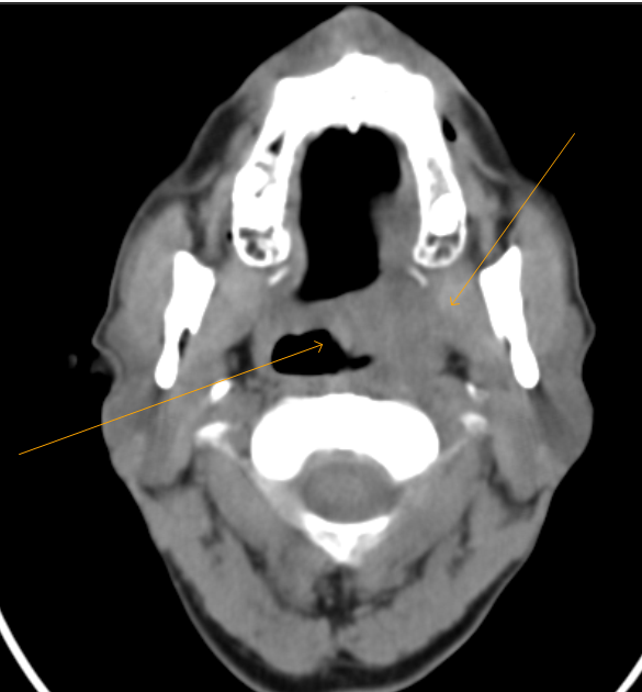 Carcinoma TonsilCT Sumer's Radiology Blog