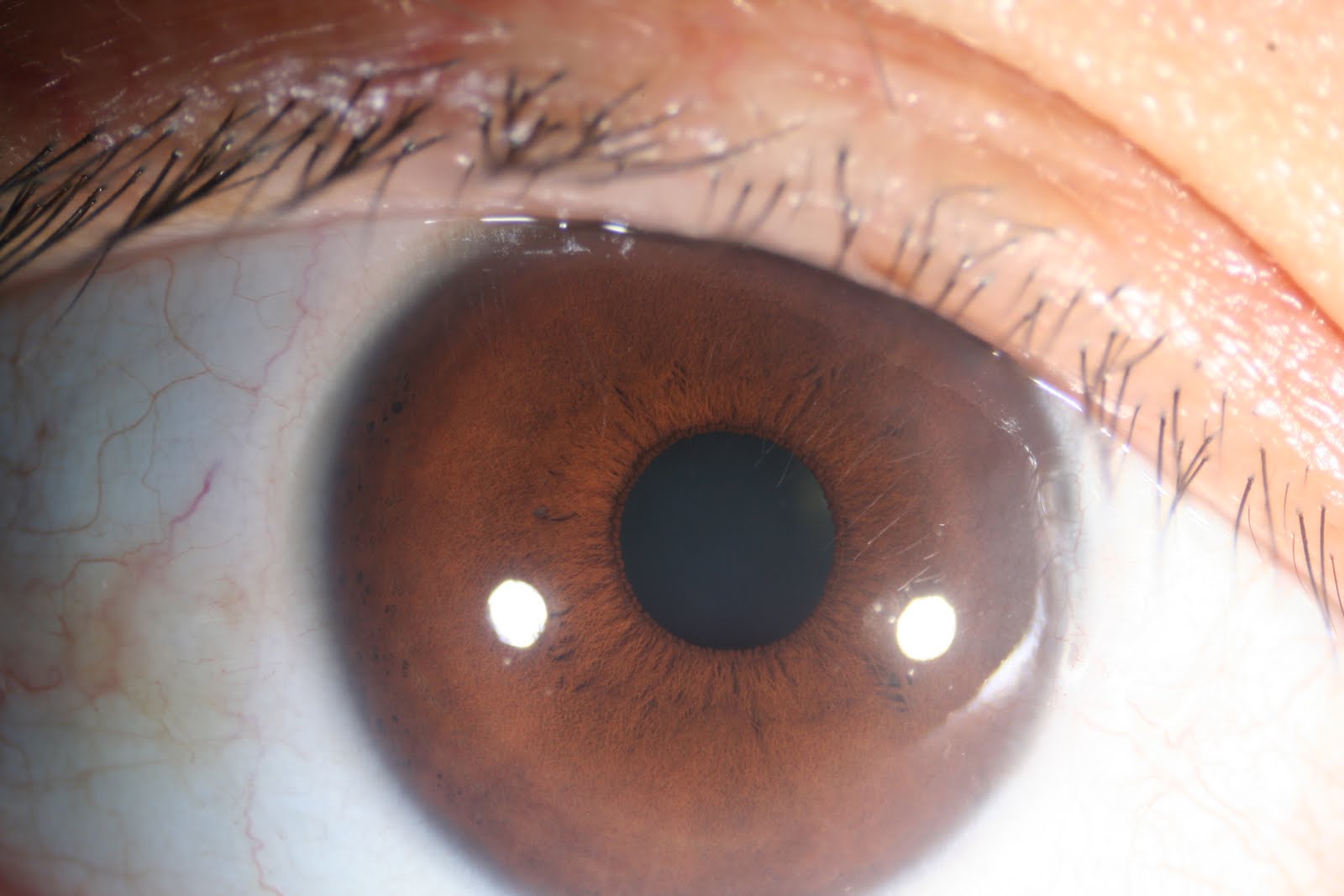 Iris Sclera