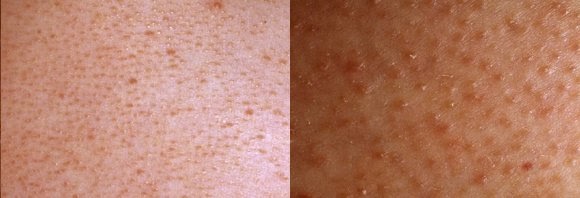 Do you have small red bumps on your upper arms? | Memorable Days
