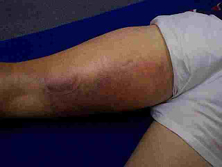 hamstringbruise%5B1%5D.jpg