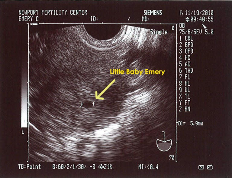 early sonogram picture early sonogram picture
