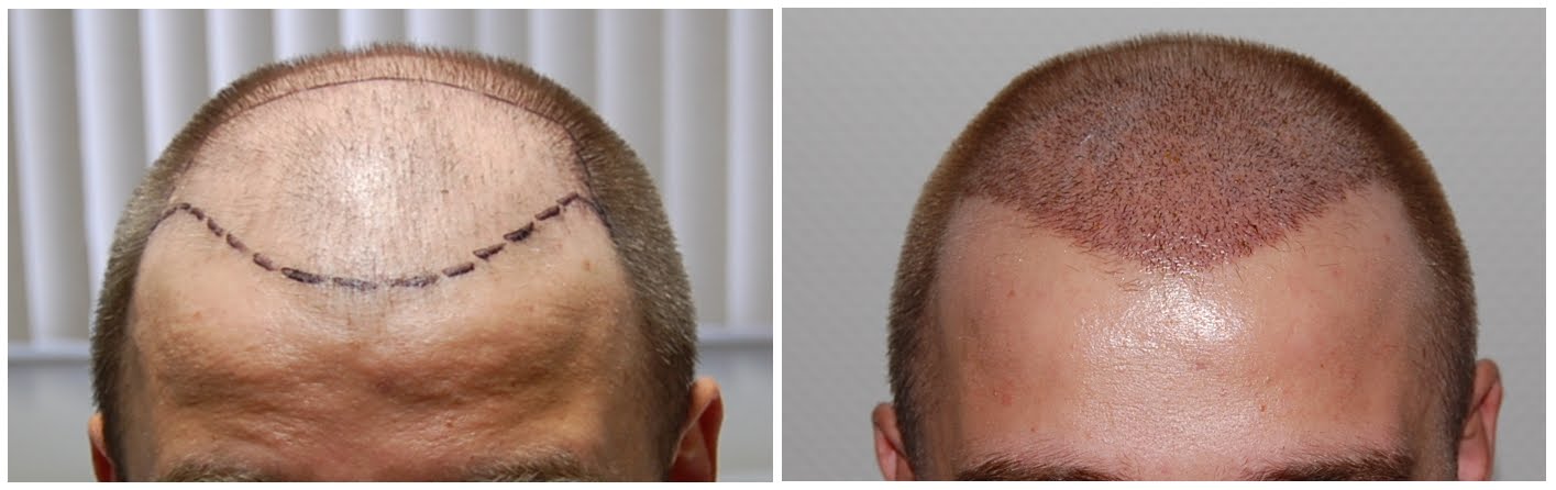 http://1.bp.blogspot.com/_ome05PyQeQ4/TL1ZOjXT-KI/AAAAAAAAAOE/2nJ_p9AnoQ8/s1600/Haartransplantation+FUE+Vorne+1.jpg