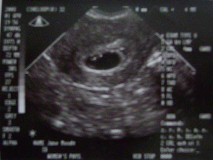 6 Week Sonogram