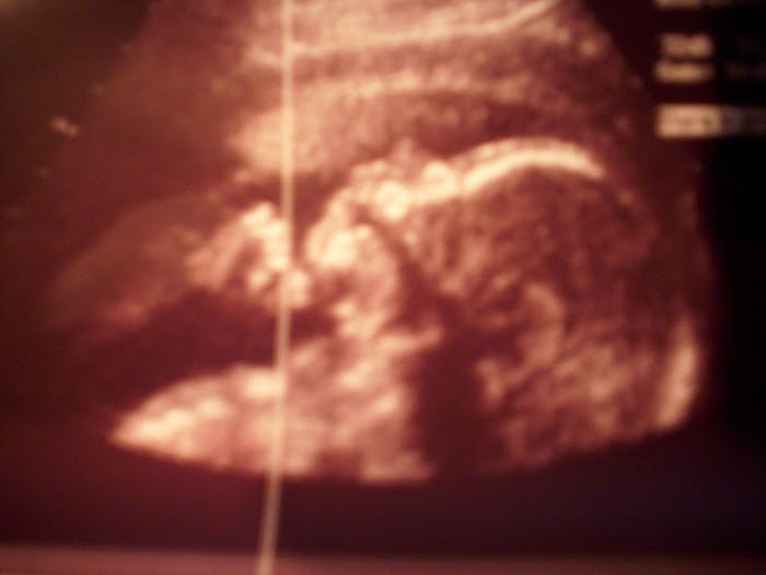 22 Week Sonogram I