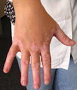 e white spots without being How to remedy Whitened Spots on Skin Popular tips