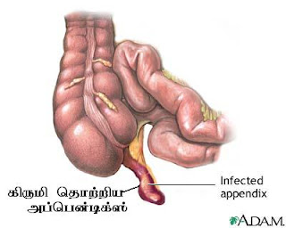 அப்பன்டிசைடிஸ் (Appendicitis)- கல் அடைப்பது அல்ல Infected+appendix