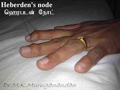 மூட்டுத் தேய்வு நோயை இனங் காட்டும் ஹெர்படன்ஸ் நோட் (Heberden's Node) Herbedes+node+Named