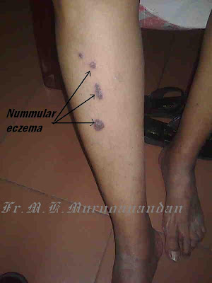 இதுவம் ஒரு வகை தோல் நோய் - நுமலர் எக்ஸிமாNummular eczema  Nummular+eczema+2