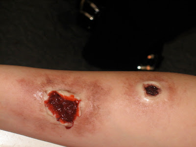 Gunshot Entry Wound