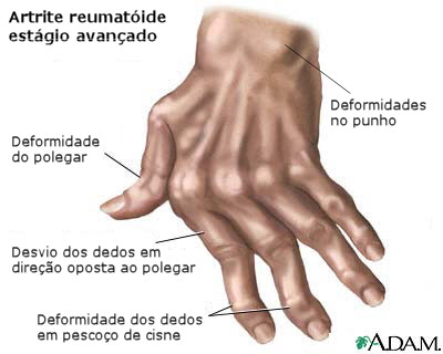 Artrite reumatóide - mãos