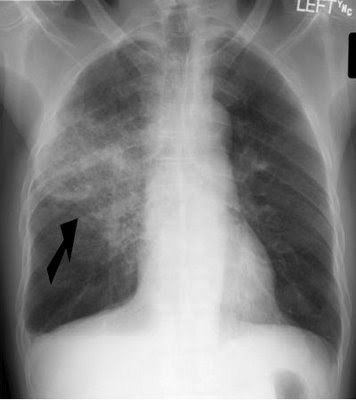 Pneumonia Picture